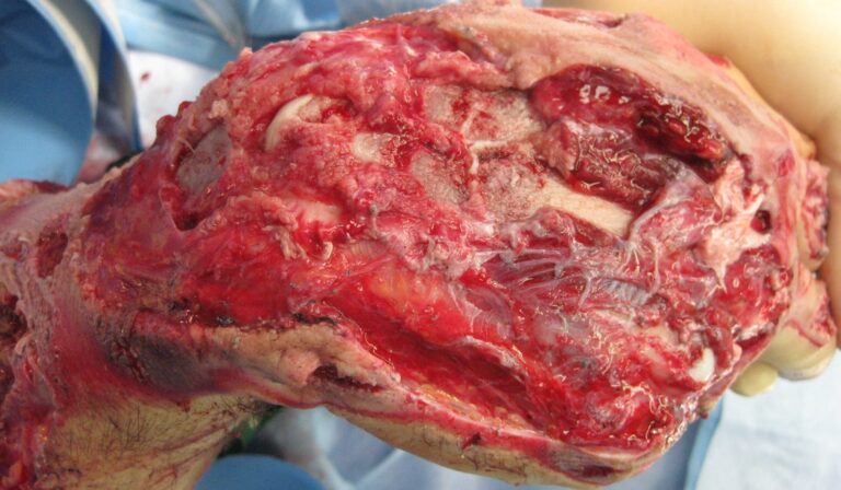 The top of my right hand just hours after the accident.