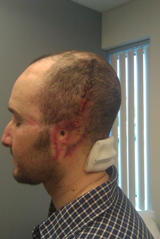 Post tissue expander surgery