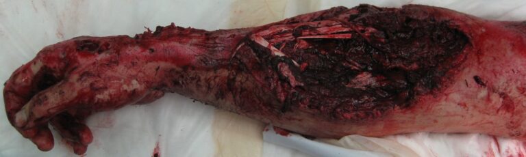 The top of my right hand just hours after the accident.