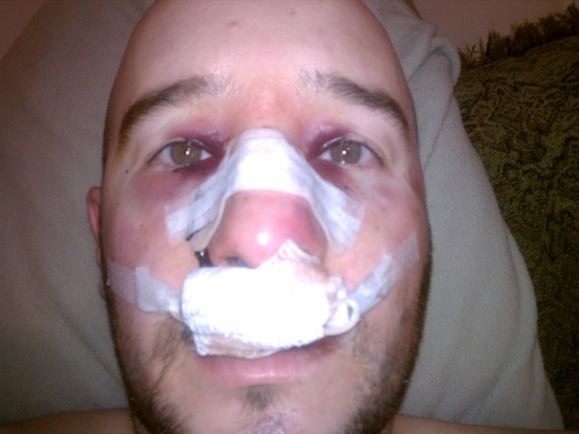 Recovering from head surgery!