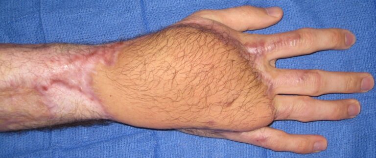 The top of my right hand just hours after the accident.