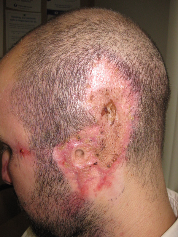 Pre-tissue expander insertion.